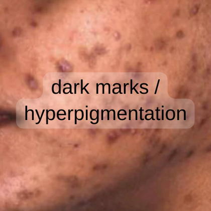 Dark Marks / Hyperpigmentation